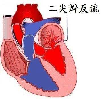 主动脉瓣返流是什么意思? 主动脉瓣返流是什么意思