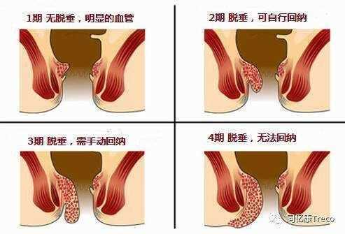 为什么会长痔疮主要是什么原因-为什么会发痔疮