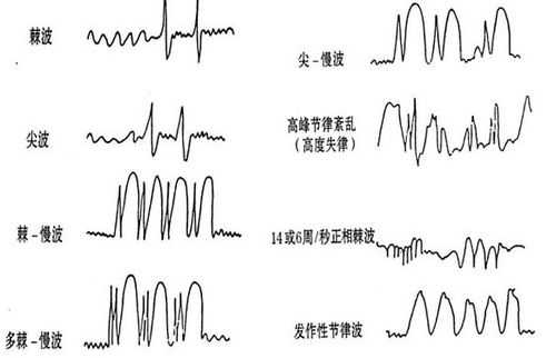 脑电图中度异常是什么意思