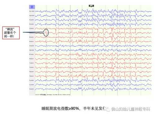 脑电图中度异常是什么意思