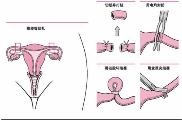 女人结扎会老的快吗-做绝育手术对女人有什么影响