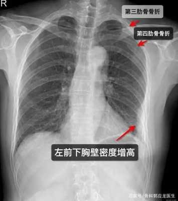 排除隐匿性骨折是什么意思 隐匿性骨折是什么意思