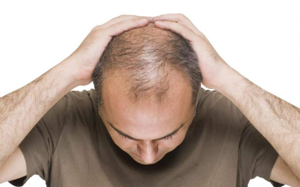 男士脱发是什么原因引起的（男士脱发怎么调理头发才能长出来）