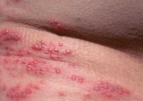 什么是生殖疱疹症状-什么是生殖