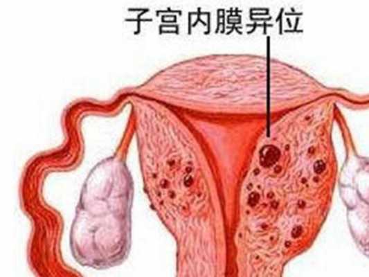 子宫内膜异位症有什么症状表现