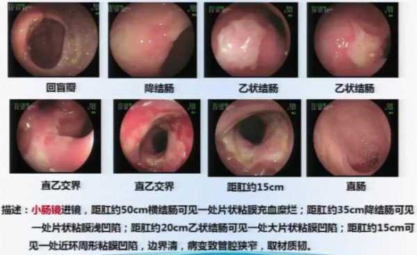 肠结节的症状-结肠结节是什么症状