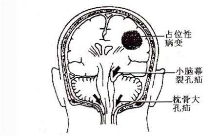  脑疝是什么症状「脑疝是什么症状怎样治疗」