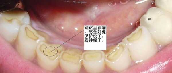 为什么牙根疼