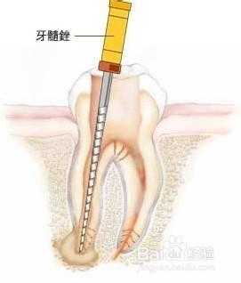 为什么牙根疼