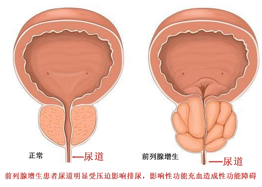 什么是前列腺,什么是前列腺增生症状 