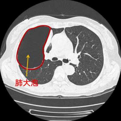 肺叶大泡是什么意思