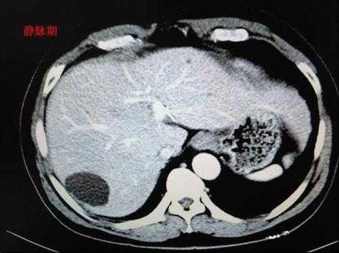 什么是肝内低密度灶（肝有低密度灶是病吗）