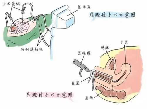 宫腔镜是什么手术