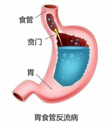 食管反流是什么