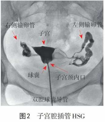 做输卵管造影有什么危害和后遗症