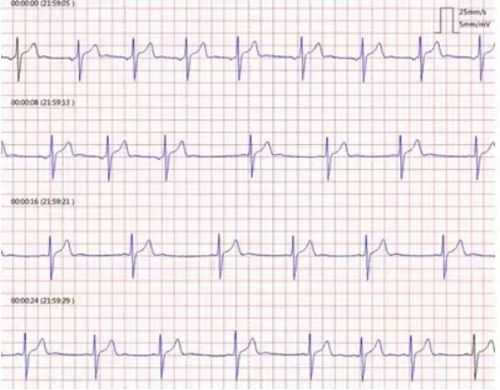 心电图能查出什么症状 心电图能查出什么