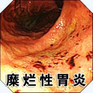 慢性糜烂性胃炎是什么意思-糜烂性胃炎是什么意思