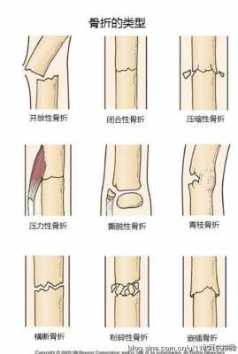 骨折是什么意思