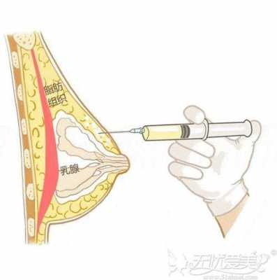 自体脂肪填充胸部可以维持多久?安全吗-自体脂肪填充胸部有什么危害