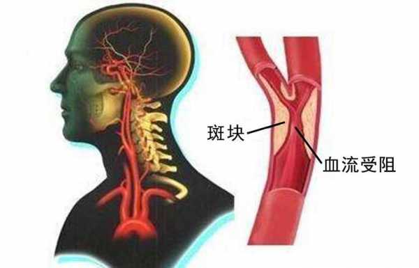 什么是颈动脉斑块_什么是颈动脉斑块图片高清