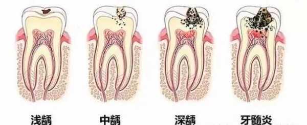 成人蛀牙是什么原因引起的-蛀牙是什么原因引起的