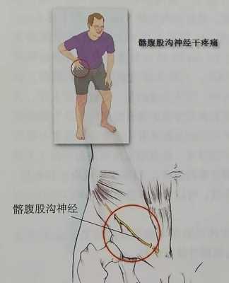 腹沟炎有什么症状男性（男性左腹股沟疼痛的原因引起）