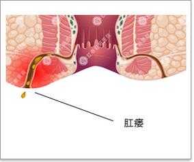 肛周脓肿形成肛瘘是什么症状