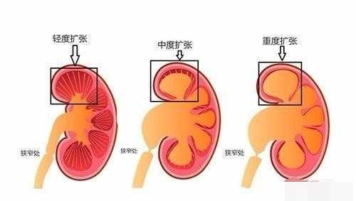 右肾肾盂分离什么意思_右肾肾盂分离什么意思胎儿