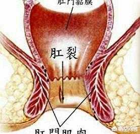 屁眼痛是什么病的简单介绍