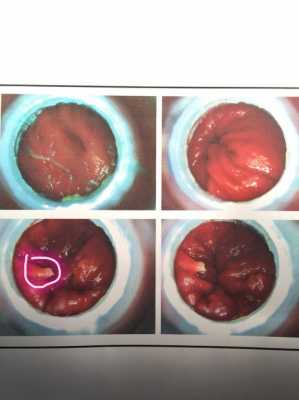 肛息肉是什么症状图片（肛门口有个肉球照片）