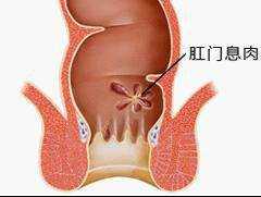 肛息肉是什么症状图片（肛门口有个肉球照片）