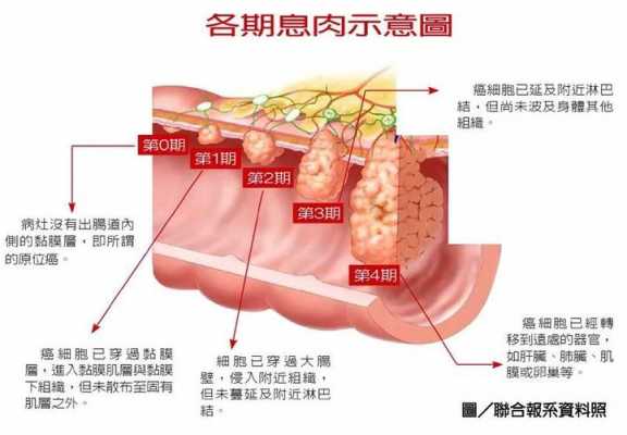  息肉是什么「息肉是什么原因引起的啊」