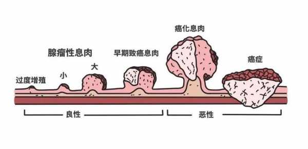  息肉是什么「息肉是什么原因引起的啊」