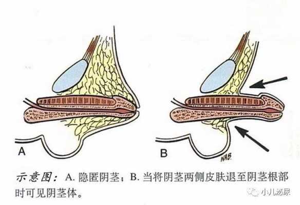 阴茎埋线是什么意思的简单介绍