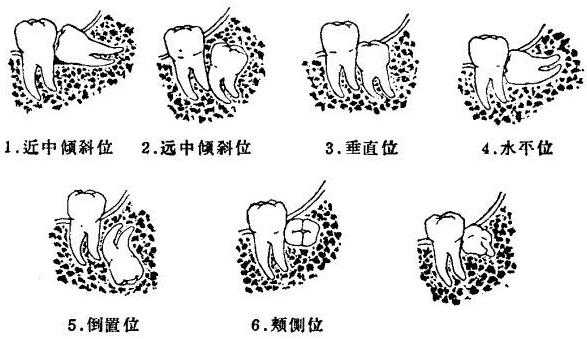 什么是阻生牙（什么是阻生牙?）