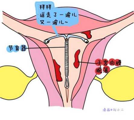 避孕环的原理是什么意思 避孕环的原理是什么