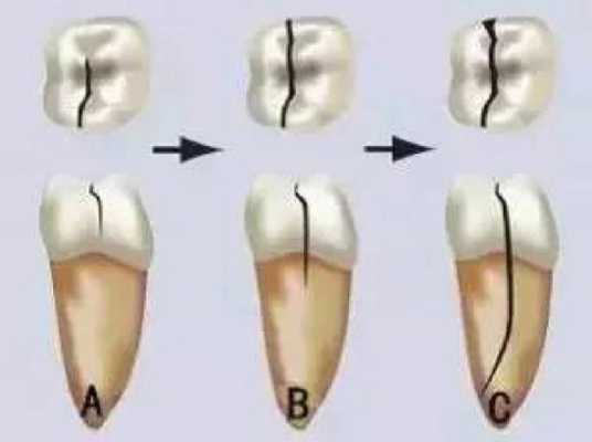 牙齿隐裂是什么原因