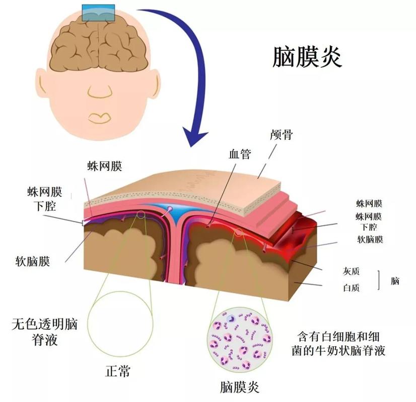 脑膜炎是什么_脑膜炎是什么症状