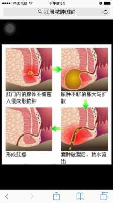 肛瘘是什么原因引起,肛瘘是什么原因引起的男性 