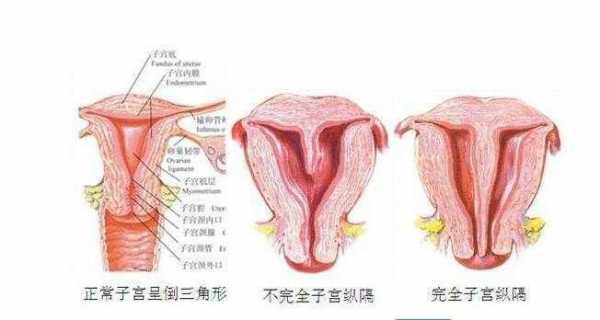 什么是纵隔,什么是纵隔子宫 