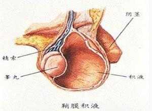 鞘膜积液是什么（睾丸鞘膜积液是什么）