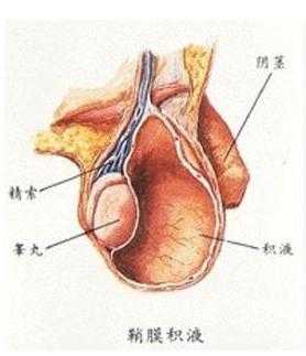 鞘膜积液是什么（睾丸鞘膜积液是什么）