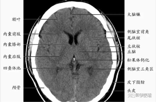  双侧基底节区腔隙灶是什么意思「双侧基底节区腔隙性梗死严重吗?」