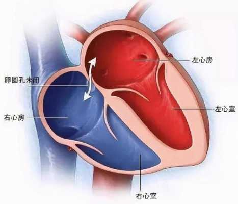 卵圆孔未闭要注意什么,卵圆孔未闭要注意什么有助于闭合 