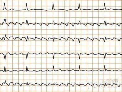 心电监护仪rr什么意思（心电监护仪怎么看rr过高是什么意思）