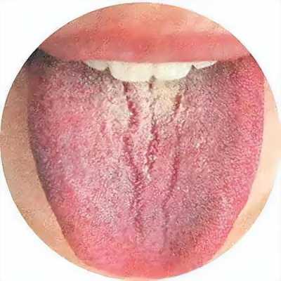 舌头上裂纹很深是什么原因引起 舌头上裂纹很深是什么原因