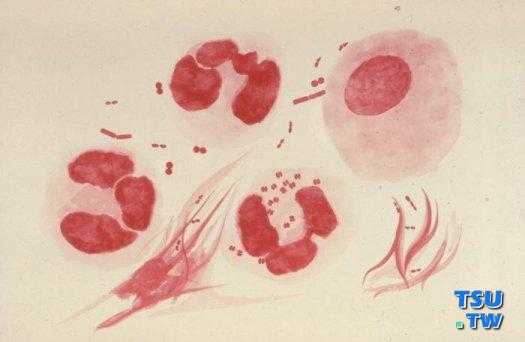 淋球菌阳性是什么病_淋球菌阳性是什么病好不好治疗