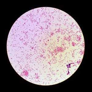 淋球菌阳性是什么病_淋球菌阳性是什么病好不好治疗