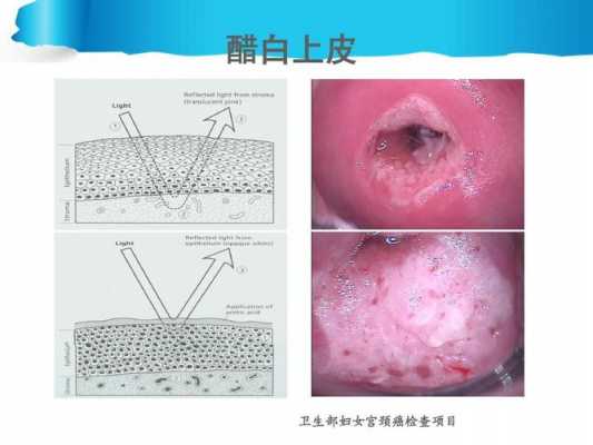  薄的醋酸白色上皮是什么意思「薄醋白上皮是什么意思」