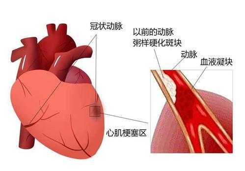 冠状动脉是什么意思,冠状动脉钙化是什么意思 